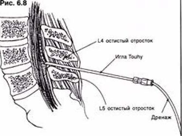 Установка люмбального дренажу 6 Херсон