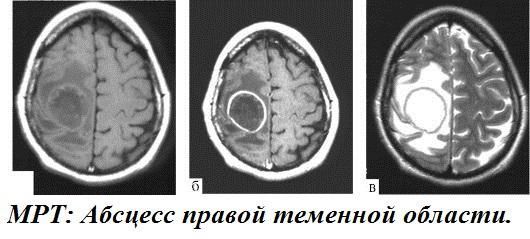 Оперативное лечение инфекционных поражений мозга 3 фото infekcionnye porazheniya operativnoe