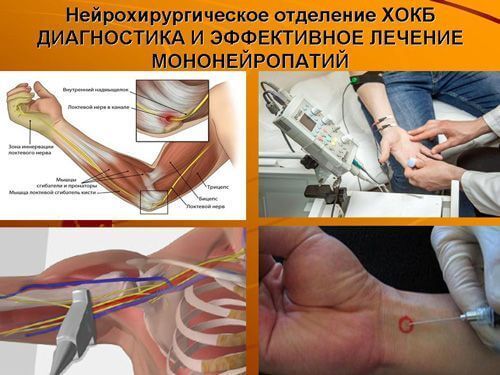 Блокады с кортикостероидами, анестетиками и фиксация конечности 3 фото mononeiropatiya