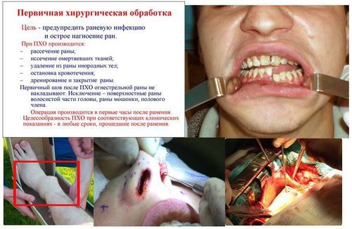 operativnoe lechenie pri legkoy chmt 1