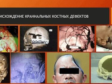 Краниопластика 8 Херсон