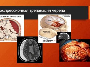 Краниопластика 9 Херсон