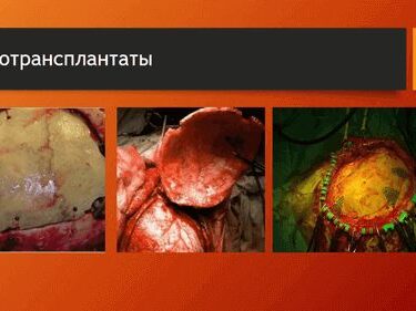 Краниопластика 10 Херсон