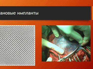 Краниопластика 11 Херсон