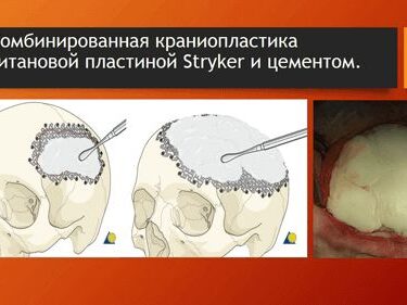 Краниопластика 13 Херсон