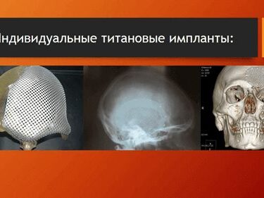Краниопластика 14 Херсон