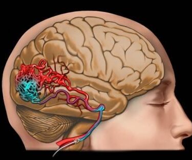 Эндоваскулярная эмболизация 6 Херсон