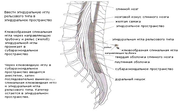 Установка люмбального дренажа 2 Херсон