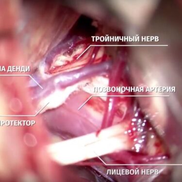 Мікроваскулярна декомпресія (операція Джанетта) 8 Херсон