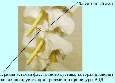 Радиочастотная денервация межпозвонковых суставов 9 Херсон