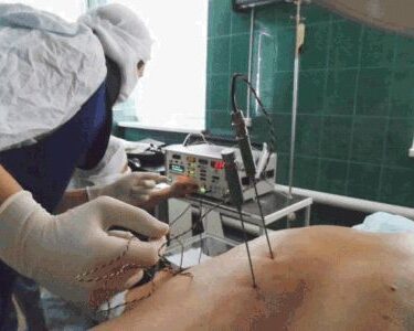 Радиочастотная денервация межпозвонковых суставов 10 Херсон