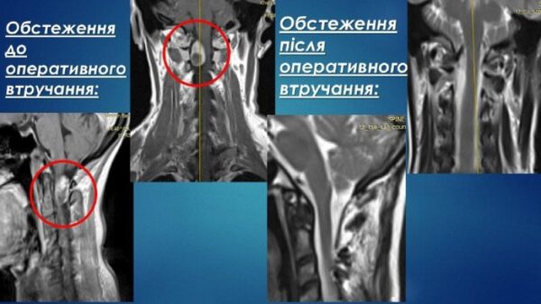 Виконано видалення пухлини складної локалізації