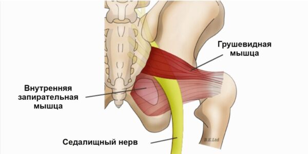 Синдром поражения седалищного нерва 3 фото Cиндром грушоподібного м'язу