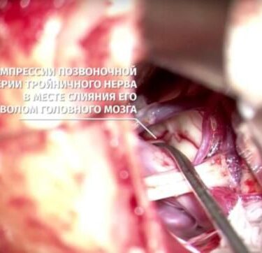Невралгія трійчастого нерва 6 Херсон