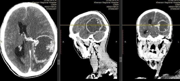 Операция по удалению опухоли головного мозга 19 Херсон