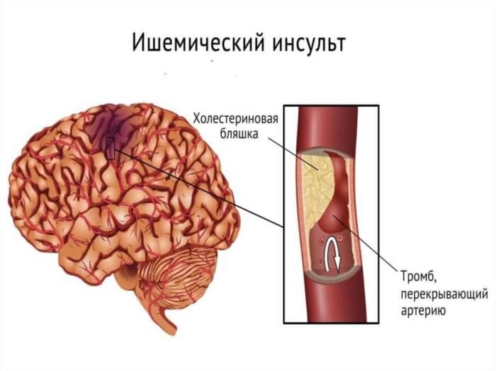 Ішемічний інсульт херсон