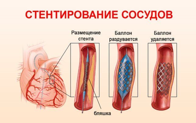 Стентування сонних артерій херсон