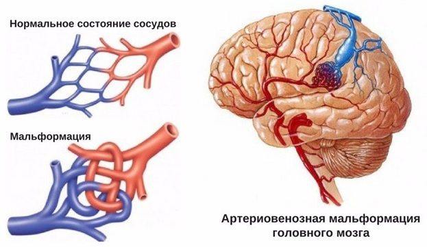 Захворювання судин головного мозку та шиї херсон