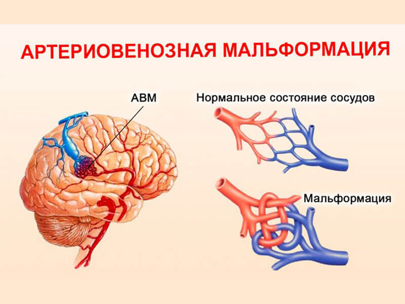 Мальформации сосудов центральной нервной системы 3 Херсон